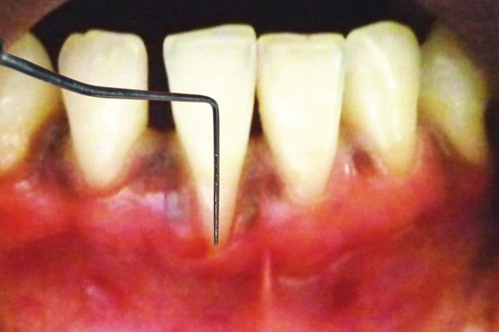 2 Case Reports in Dentistry Figure 1: 8 mm gingival recession at 41 region. Figure 3: Palatal donor site. Figure 4: FGG harvested.