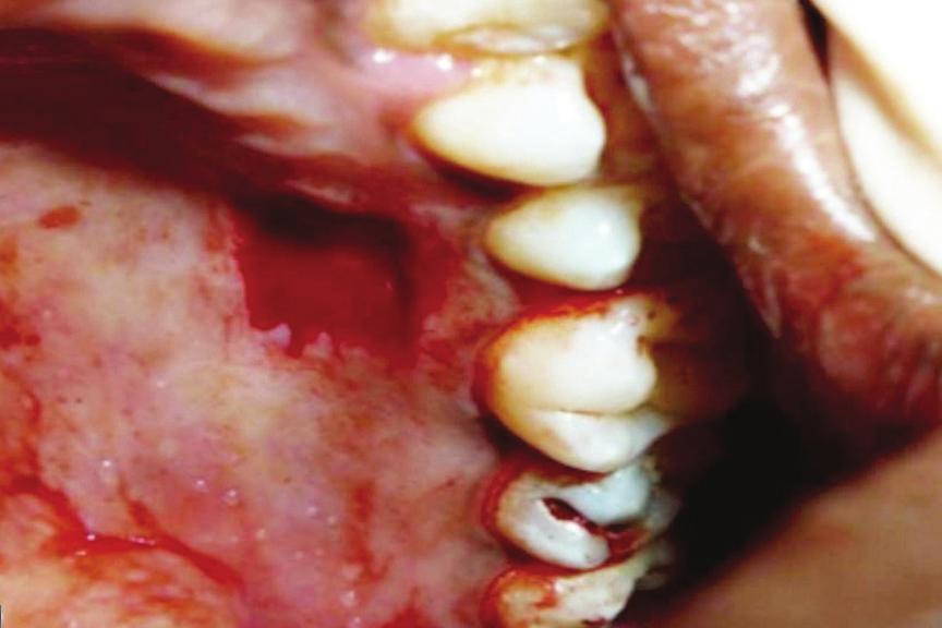 Periodontal therapy included Phase 1 therapy of thorough scaling and root planning, initiated four weeks prior to the surgery [6].