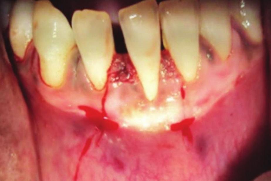 Case Reports in Dentistry 3 Figure 7: Vertical and interdental incisions made. Figure 10: Flap coronally advanced and sutures placed. Figure 8: Partial thickness flap elevated.