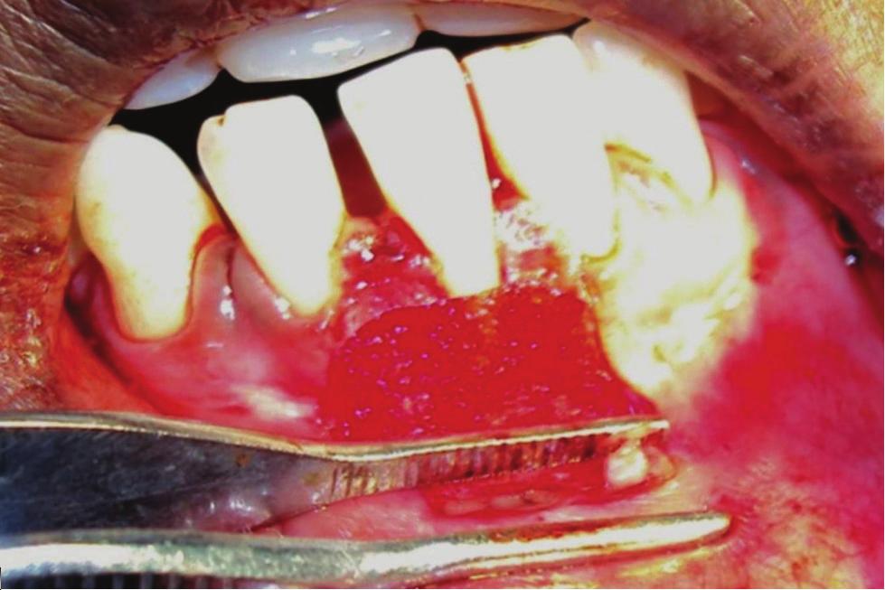 Discussion Therearemultipleapproachesdocumentedintheliterature for the treatment of gingival recession defects but there are not many dealing with the treatment of Miller class III recessions [8, 9].