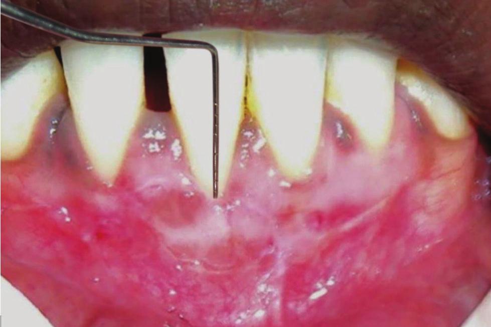 Variety of techniques have been put forward, out of which the use of FGG, in a twostep procedure, is justified because of its predictability in treating extensive gingival recession in areas where