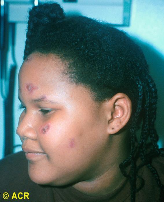 Discoid lupus: skin lesions, face Copyright 1972-2004 American