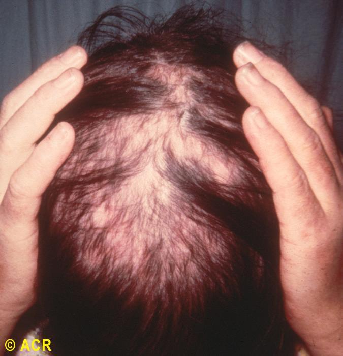 Systemic lupus erythematosus: alopecia, scalp Copyright 1972-2004