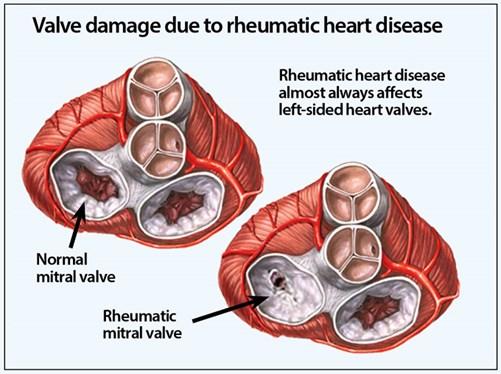 Causes Congenital Heart Disease Bicuspid Aortic Valve Marfan Syndrome