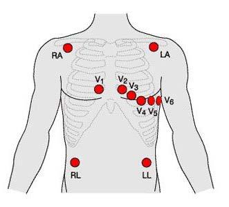 12 Lead ECG Lead= view of the heart Bipolar vs unipolar leads