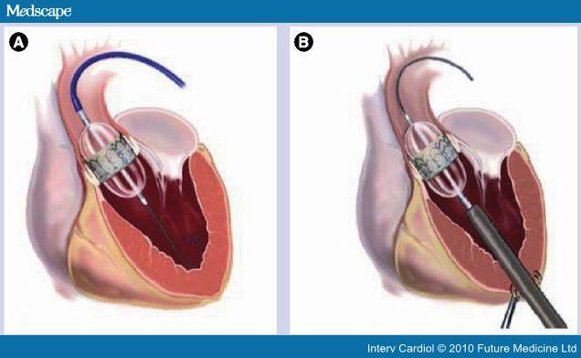 TAVI Trans Aortic Valve replacement Percutaneous aortic valve replacement For those who are not able to tolerate open heart