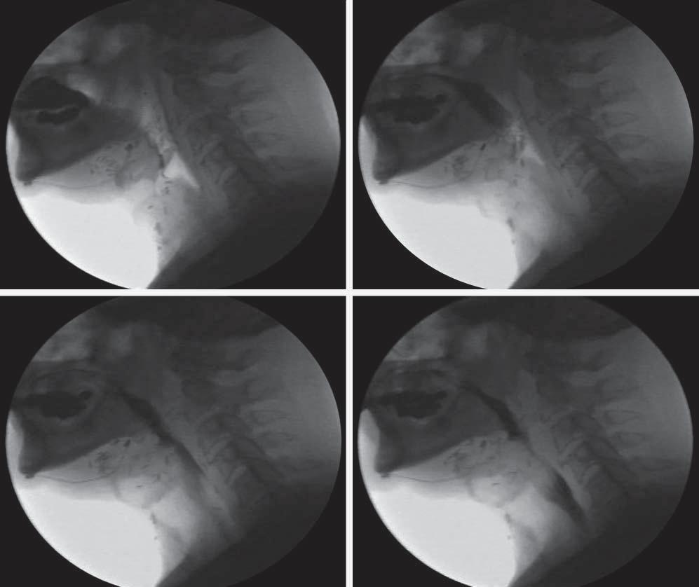 A B C D Figure 1. Single images of different points in a swallowing sequence from a videofluoroscopic swallowing study. A, Start of swallowing sequence.