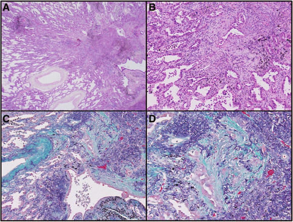 Journal of Thoracic Oncology Volume 8, Number 5, May 2013 Yanagawa et al. FIGURE 2. Nonmucinous minimally invasive adenocarcinoma.