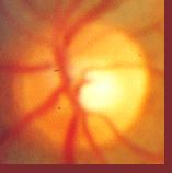 the eye in which damage occurs to the optic nerve, typically as a