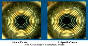 Instead of being shaped round, the cornea is shaped oval, causing a blurred image at all distances.