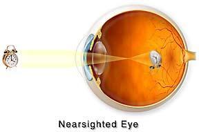 (Nearsightedness)-Distant objects are unclear in cases of myopia.