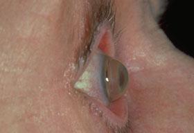 The microkeratome separates the surface layers of the cornea, and the corneal flap is folded back.