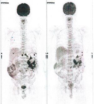 CASE NO: 17 (PANCREATIC CANCER) Middle-aged man with pancreatic cancer that has spread to the anterior abdominal wall, and no currently available treatment can stop the progression.