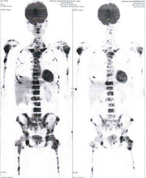 CASE NO: 4 (PROSTATE CANCER) A middle-aged man with castration resistant prostate cancer and massive bone metastases, failed all currently available cancer treatment, including with the new and