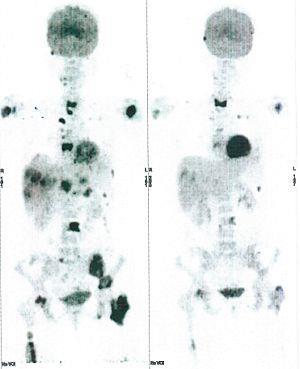 CASE NO: 7 (BREAST CANCER) A middle-aged woman treated for breast cancer now presents with bone and liver metastases.