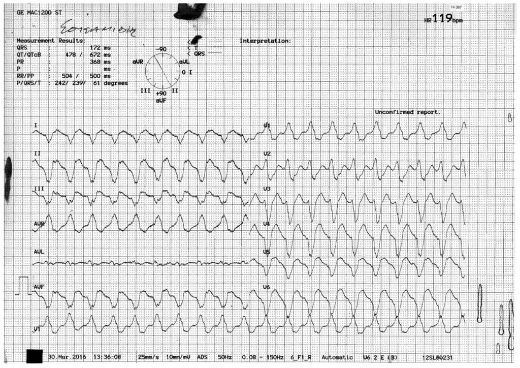 Clinical VT Slow VT (below the ICD activation zone for therapy (120 bpm)