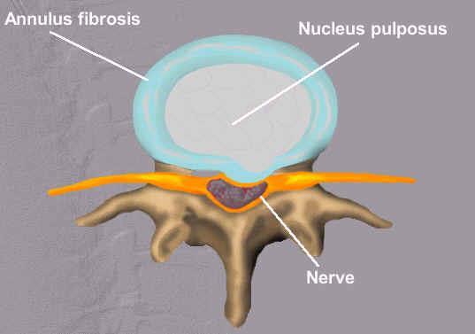 C. Herniated Disc 1. nucleus pulposus ruptures through the fibrocartilage 2.