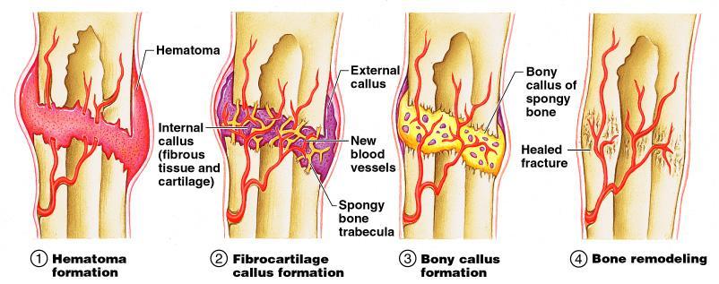 Repair of Bone Fractures Hematoma (blood-filled swelling) is formed Break is splinted (immobilized) by fibrocartilage