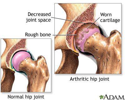 Arthritis Inflammation of one or more joints Breakdown of cartilage causes bones to rub