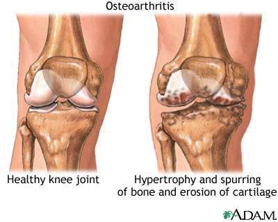 Arthritis Osteoarthritis (OA) Most
