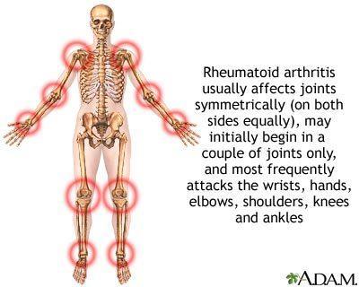 Arthritis Rheumatoid