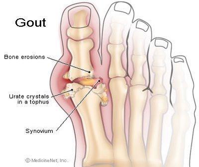 Arthritis Gout Type of arthritis