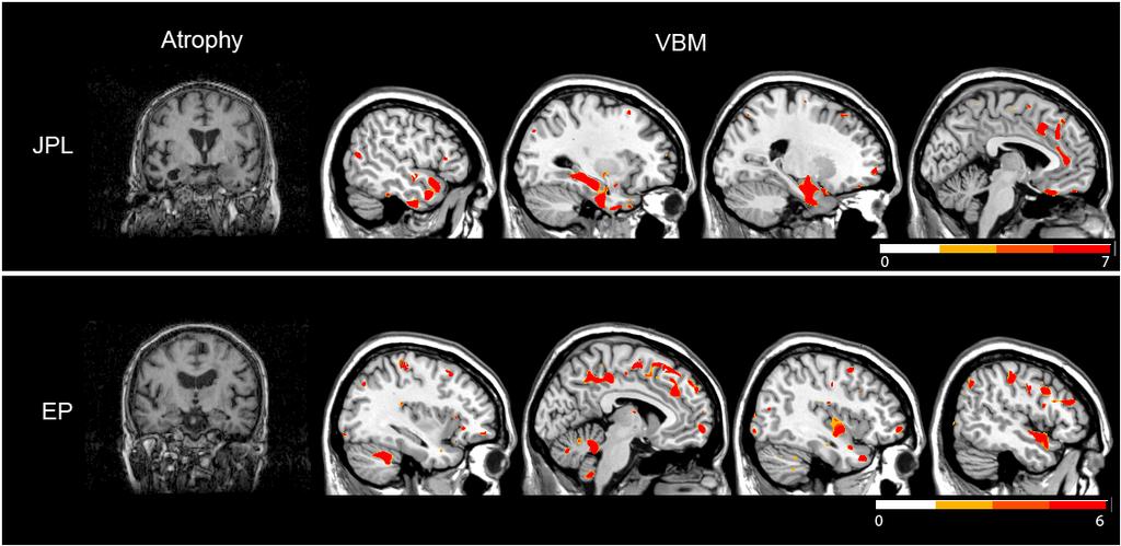 Figure 1 : Structural brain scans of patients JPL and EP. Left panels show coronal sections through the brains of JPL and EP.