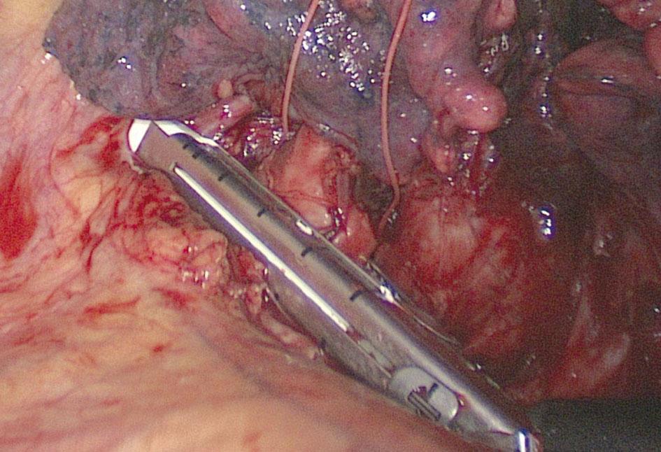 Video-assisted thoracic surgery pneumonectomy: the first case report in Poland with a vascular (white cartridge) 45 mm long endo - stapler (EndoGIA Ultra, Covidien, Mansfield, USA) (Figure 2).