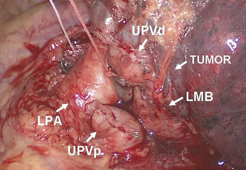 Next the dissection of the main left pulmonary artery was completed.