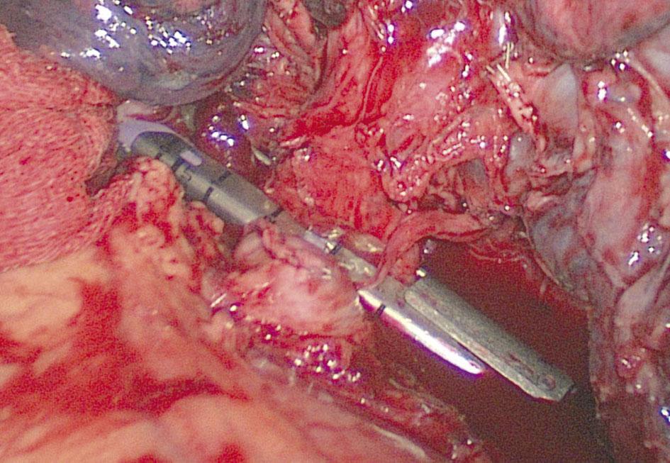 The 45-mm long vascular endostapler was introduced through the posterior port and the main left pulmonary artery was dissected (Figure 4).