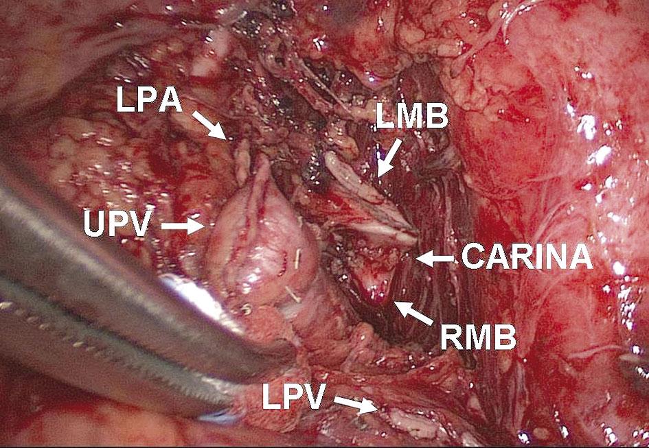The left main bronchus was then dissected and cleared from the surrounding tissue up to the level of the carina and closed and stapled with 45-mm long green (4.5 mm) reload (Figure 5).