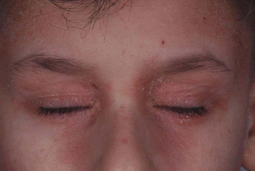 1. Around the eyes Any area of dermatitis within the confines of the orbital cavity affecting