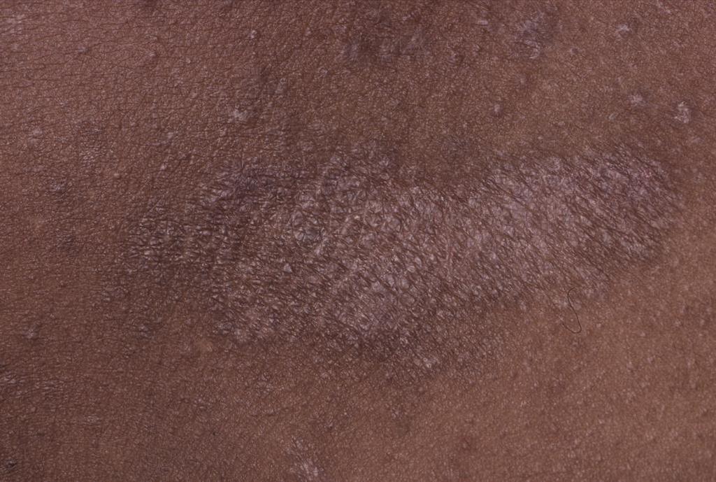 ... I cannot see any redness? In a black skin in particular, redness may be difficult to see.