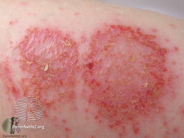 least 5 circular eczema patches