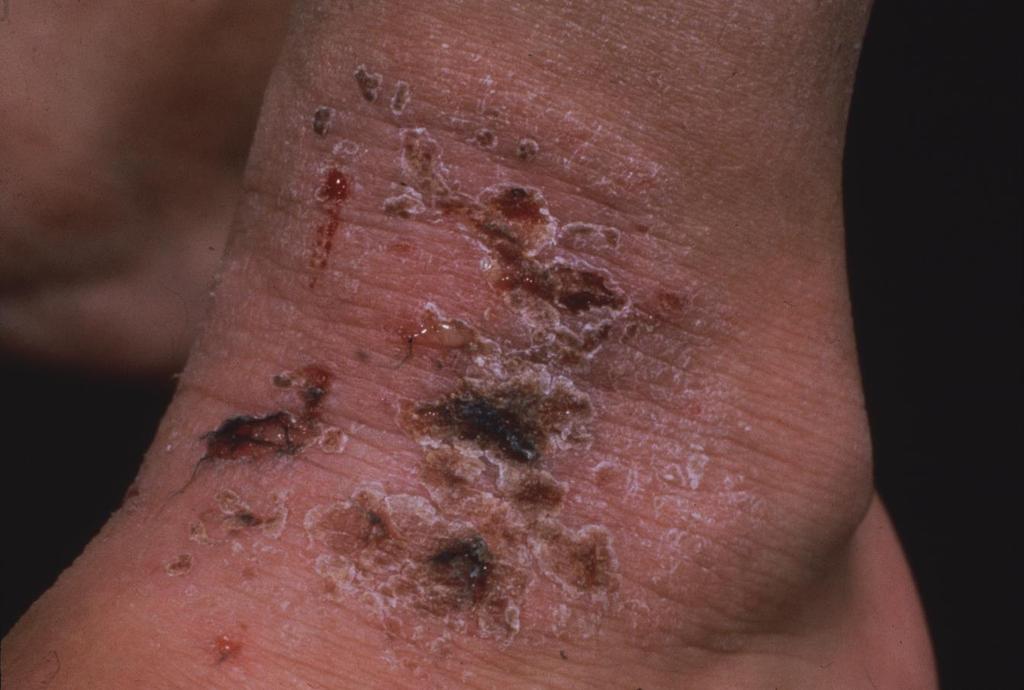 2. This is dermatitis showing another type of surface change, in this