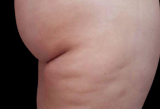 rhytidectomy and liposuction results.