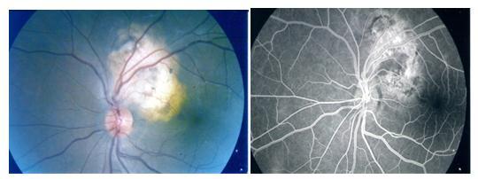 Fig-3: initial visual acuity of patients The fundus examination found active chorioretinal foci in all patients, scar tissue in 62%, active hyalitis in retinal serous detachment in 37%, papilledema