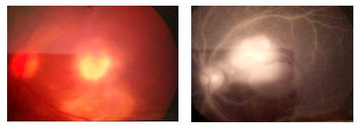 posterior poll Fig-8: Active supra-macular focus associated with a