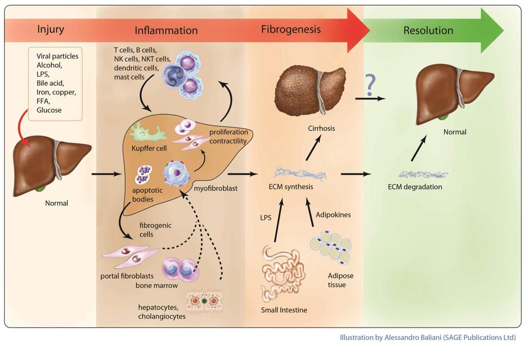 Pathogenesis of Hepatic Fibrosis -