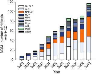Rising Contribution of NAFLD to HCC in Newcastle, UK - NAFLD accounted for 34.