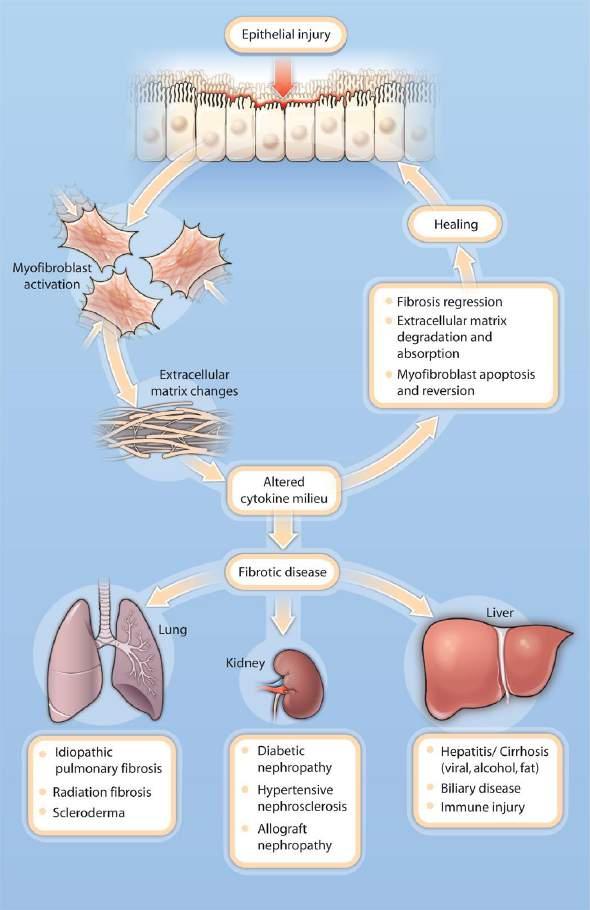 Common Events in Fibrosis Progression and Regression Across