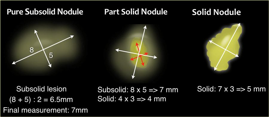 Reporting the Size of a Nodule(s) Diameter of nodule is the