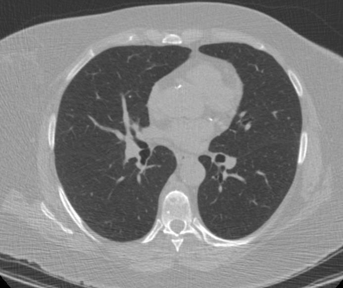 Lung- RADS Category 0 or 1 Category 0 for