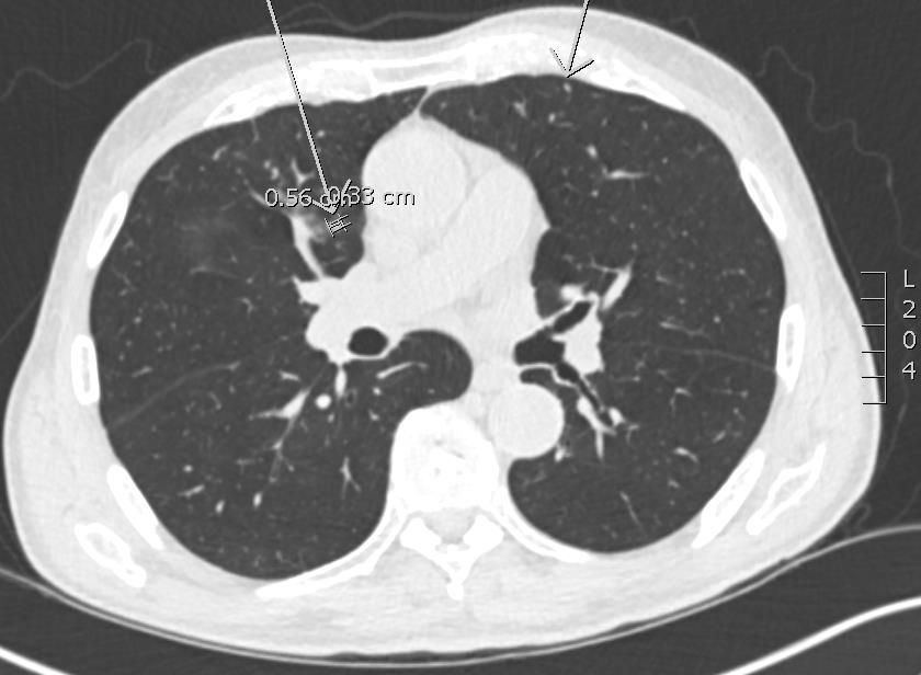 40 Lung- RADS Category 3 (1-2%)