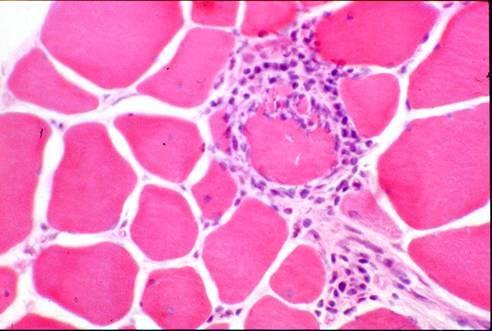 Distinguishing histologic features Polymyositis Inflammatory infiltrate within fascicle