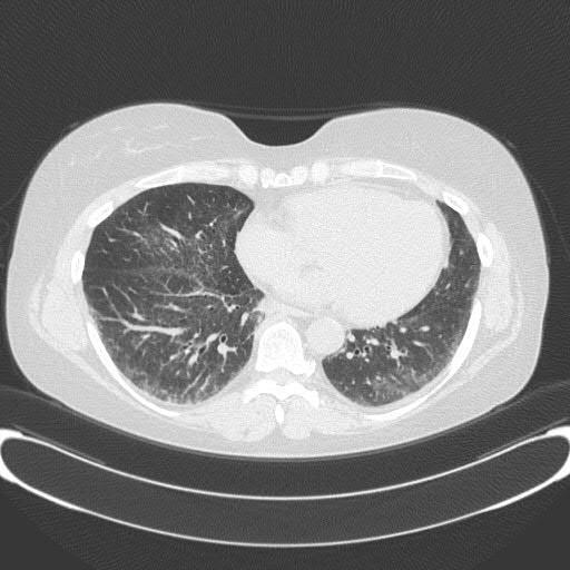 Interstitial Lung