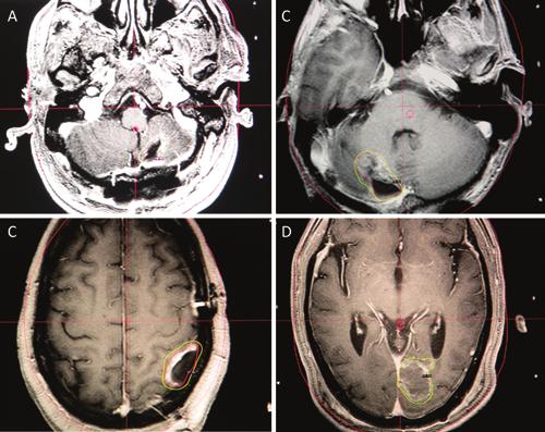 C. A. Jensen et al. cavity-directed radiosurgery following resection of a brain metastasis as a means of potentially delaying or avoiding altogether the toxicities of WBRT.