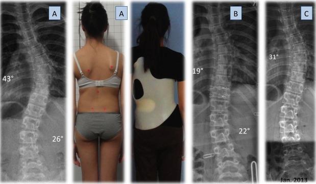 Page 4 of 6 Figure 3: Patient with AIS. (A) At an immature stage initially with 43. (B) Reasonable in-brace correction in the Gensingen brace.