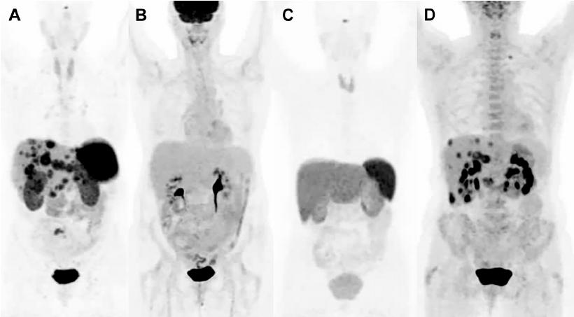 MOLECULAR IMAGING NET PHENOTYPE Octreo PET-CT FDG PET-CT