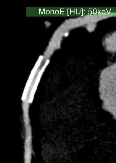 IQon Spectral CT retrospective gated cardiac CT Benefit